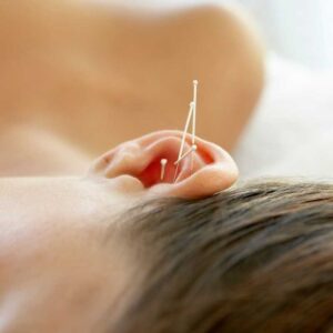oere-akupunktur